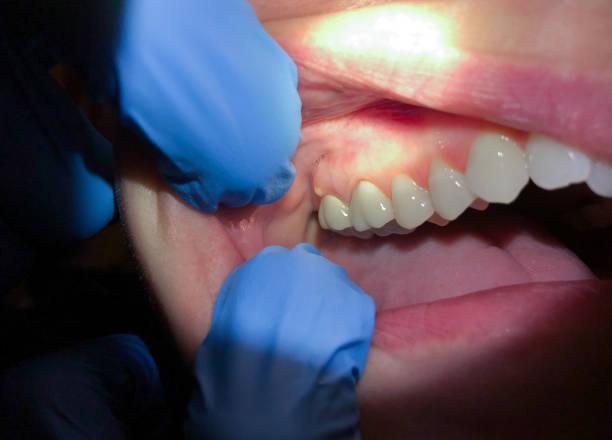 Best Emergency Wisdom Teeth Removal in Lincolndale, NY